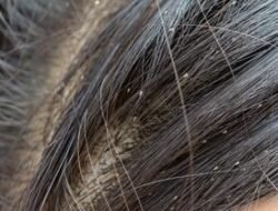 Silahkan Coba, Ini Cara Basmi Kutu Rambut