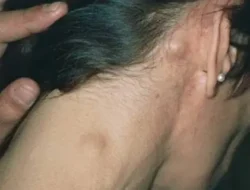Awas Kanker Limfoma, Ini Gejalanya