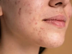Mau Tahu Penyebab Jerawat Tumbuh di Jidat, Ini Penjelasannya