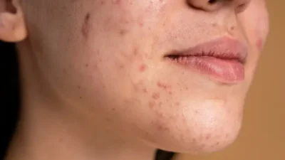 Mau Tahu Penyebab Jerawat Tumbuh di Jidat, Ini Penjelasannya