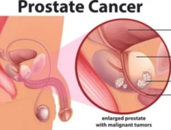 Hati Hati Dengan Kanker Prostat, Bisa Menyebabkan Kematian, Ada Enam Cara Menghindarinya, Silahkan Simak